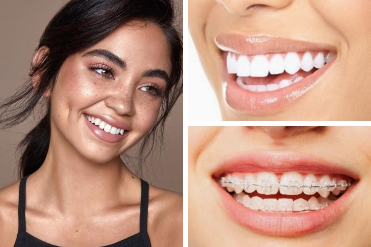 Invisalign : le nouvel appareil dentaire invisible